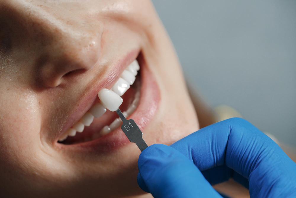 Dental Crowns: What They Are, Benefits, Procedure, and Aftercare