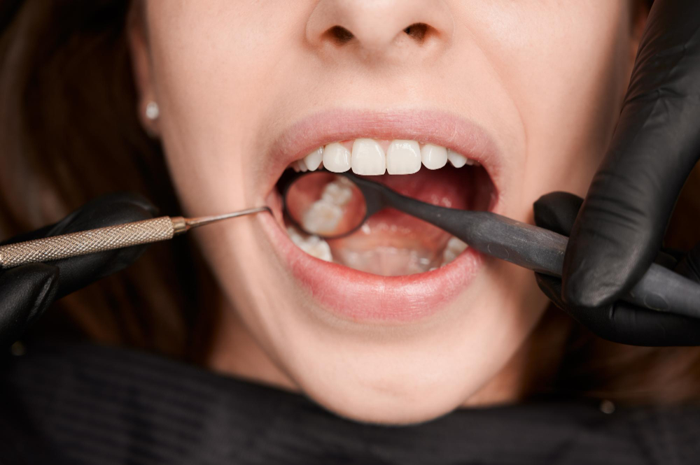 Dental Fillings: The First Line of Defense Against Tooth Decay