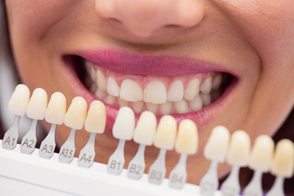 Veneers: Everything You Need to Know About Dental Veneers